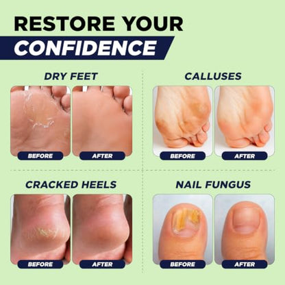 Tea Tree Callus Remover Gel & Foot Soak, Foot Cream for Dry Cracked Feet