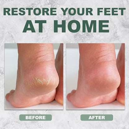 Lilac Callus Remover Tool - Professional Foot File & Callus Shaver for Feet - color: Lilac